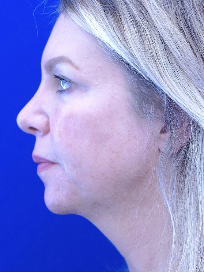 Tip Ptosis — After