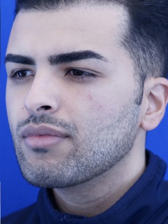 Vertical Lengthening Chin* — After