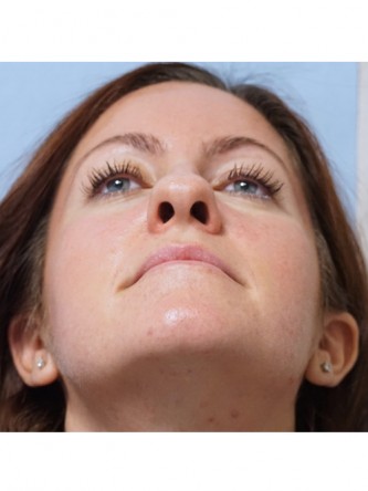 Boxy Tip Endonasal Rhinoplasty* — Before