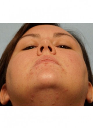 Crooked Nose Endonasal Technique2* — Before