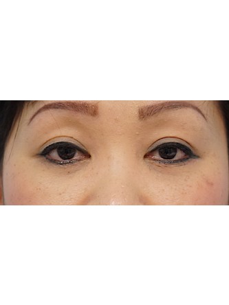 Lower Eyelid Fat Pseudoherniation* — After
