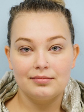 Restylane Silk Achieves Voluptuous Lips* — Before