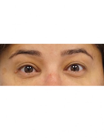 Right Ptosis Repair* — After