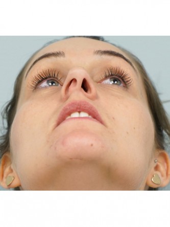 Nasal Septal Perforation1* — Before