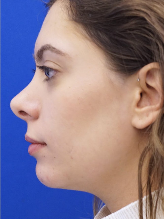 Hump Reduction and Chin Projection — After