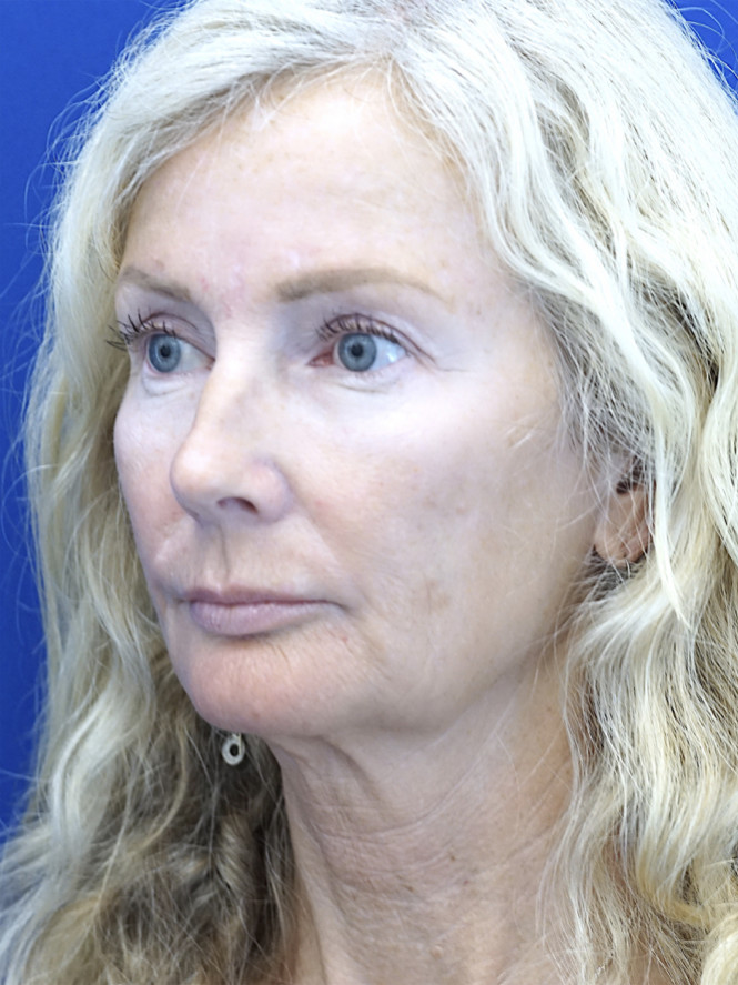 Scintillating Natural Result — Before