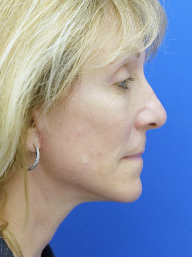 Hairline Browlift — After