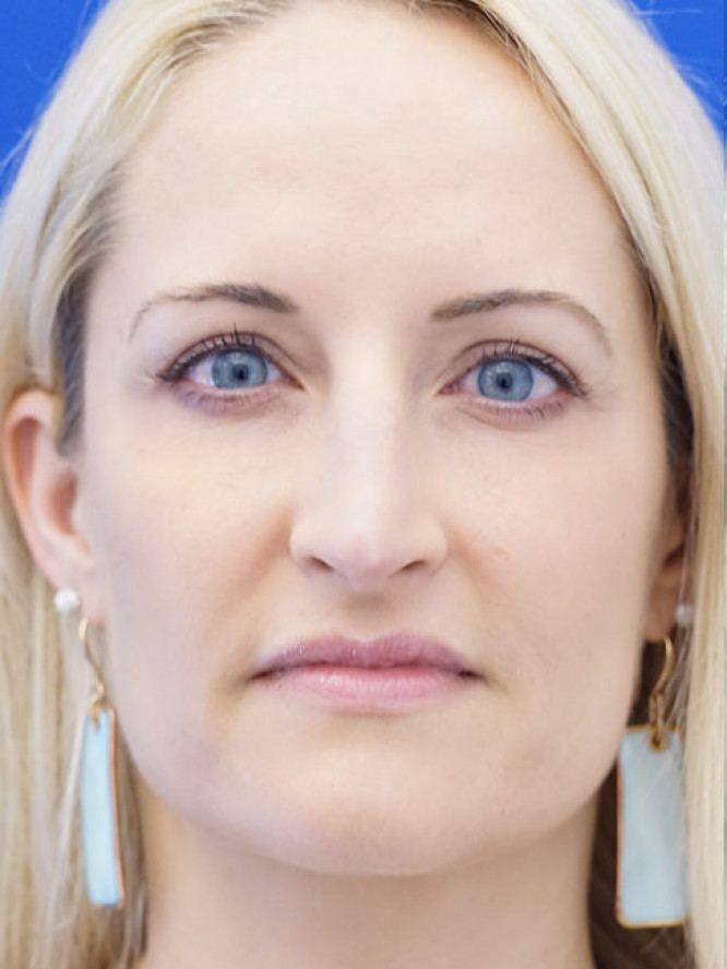 Trichophytic Browlift — Before