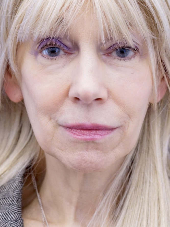 Crisp Jaw and Neck Lines — Before