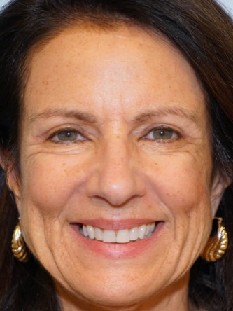 Upper Eyelid Skin Excess1* — After