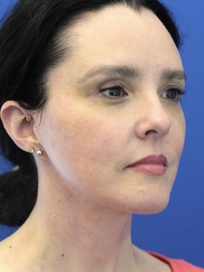 Awesome Jawline — After