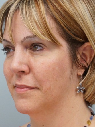Cheek Augmentation using Voluma* — After
