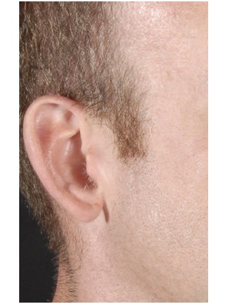Protruding Ears – Moderate* — Before