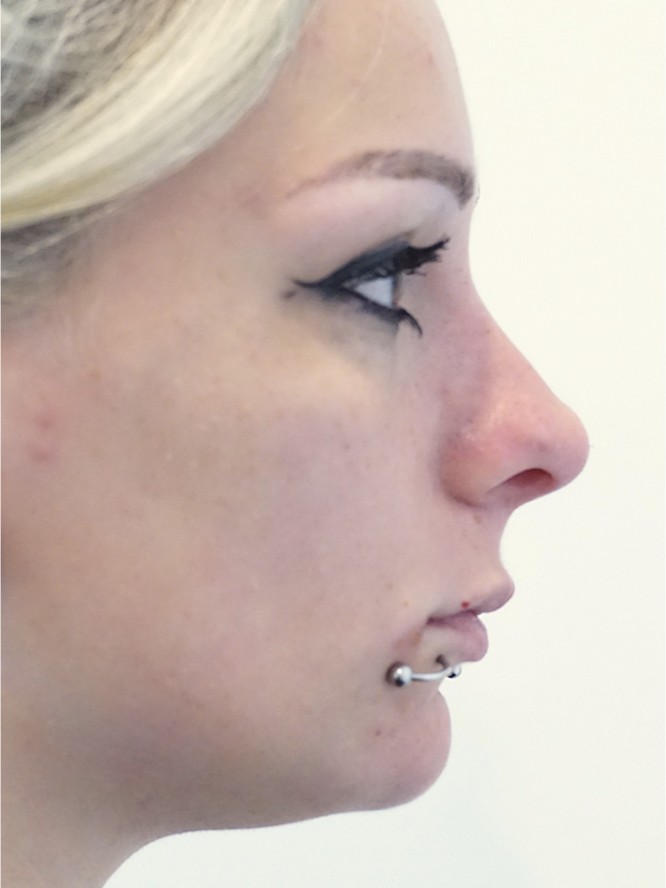 Deep Radix and Dorsal Convexity — After