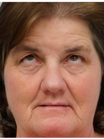 Brow Droop & Upper Eyelid Skin Excess* — Before