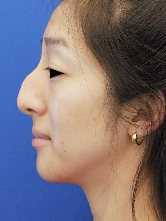 Preservation Ethnic Rhinoplasty — Before
