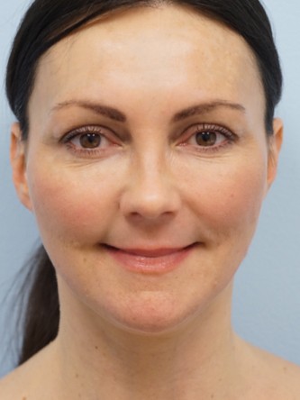Mini Lift, Laser Resurfacing, Facial Filler* — After