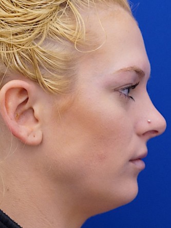 Restylane Silk Equalizes Lip Volume* — After