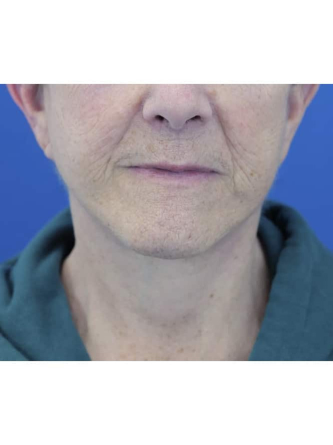 Neck Tissue Laxity — After
