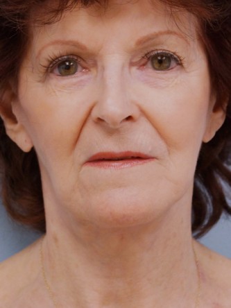 Facelift, Necklift, Platysmaplasty, ERB:YAG Laser Resurfacing* — After