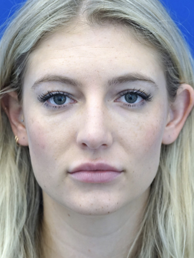 Aesthetic Nasal Contour — Before