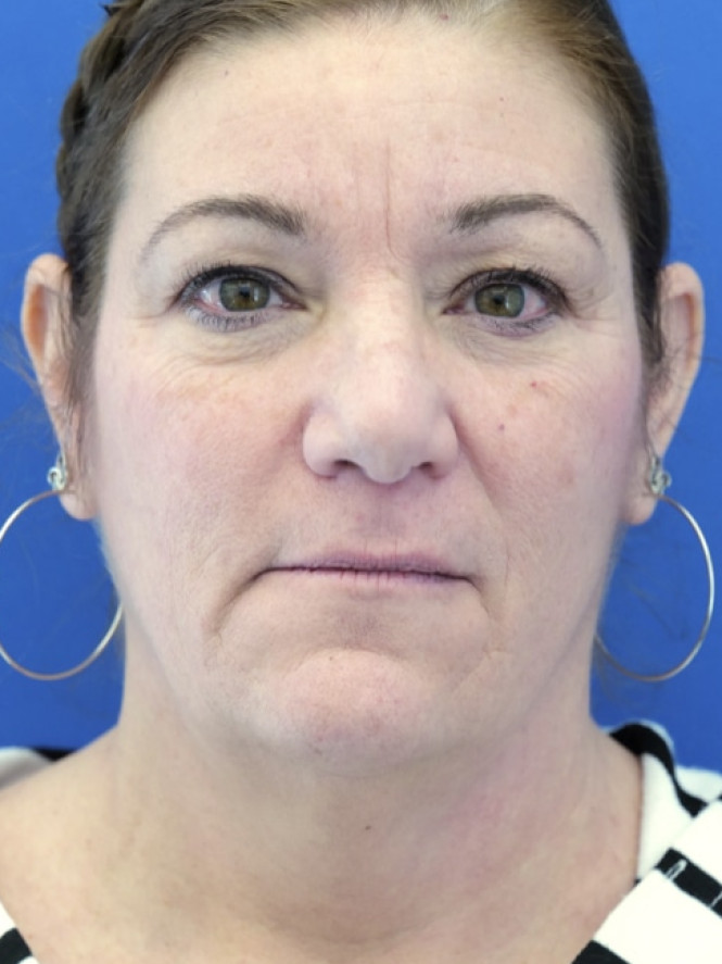 Full Upper and Lower Facelift — Before