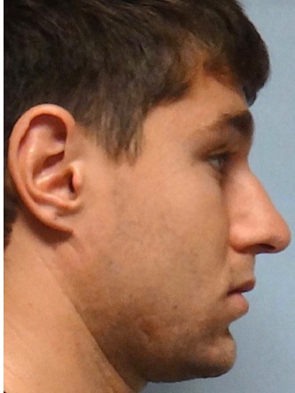 Crooked Nose & Dorsal Hump2* — Before
