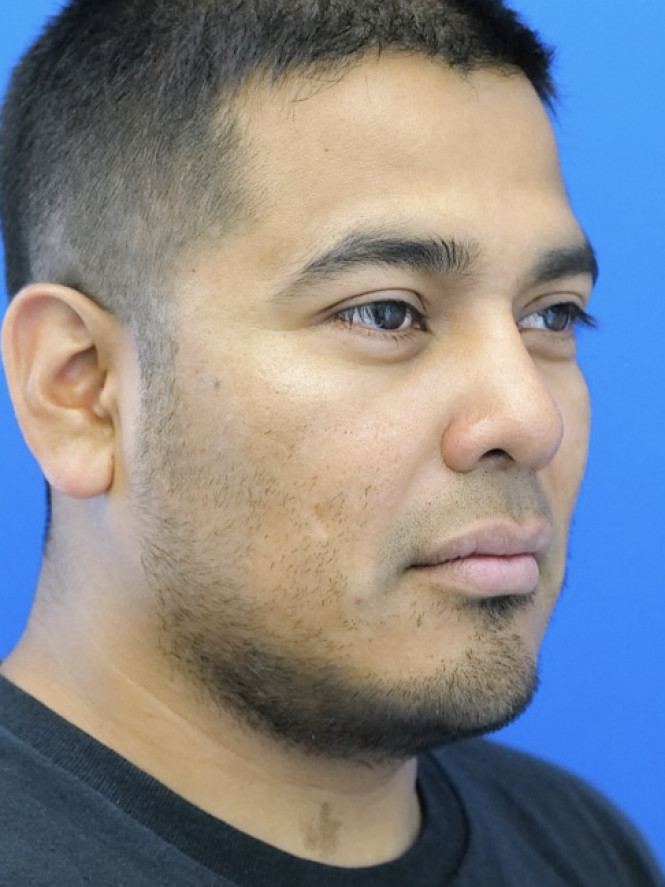 Rhinoplasty Trifecta — After