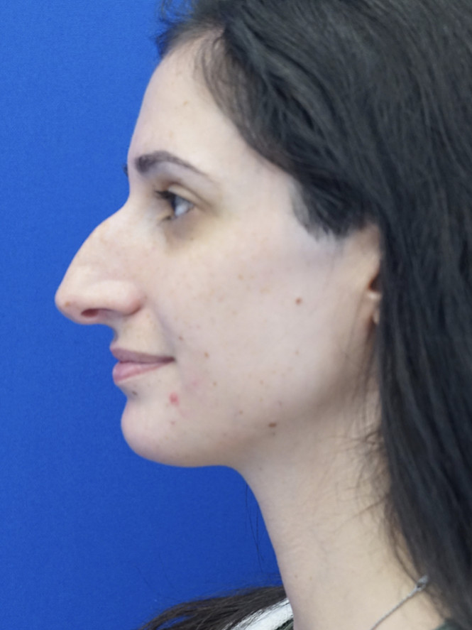 Profile Enhancement — Before