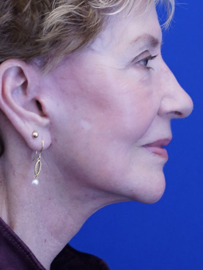 Deep Plane Facial Rejuvenation — After