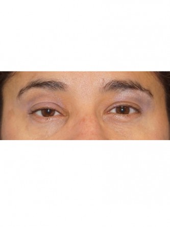 Right Ptosis Repair* — Before