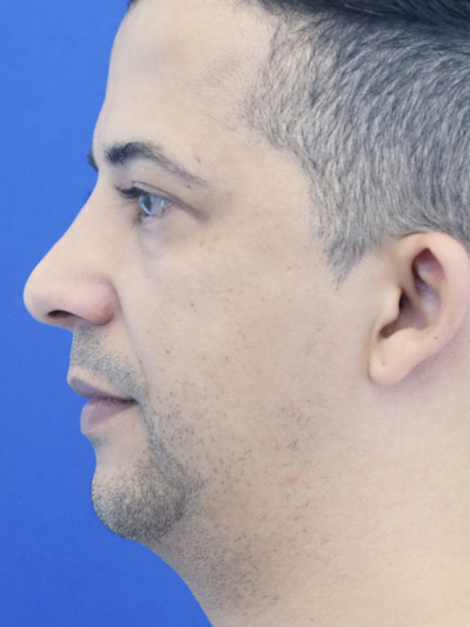 Endonasal Hump Removal — After