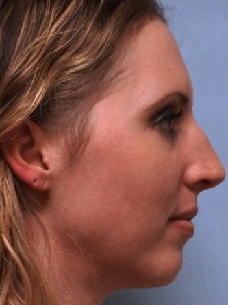 Crooked Nose & Cartilage Deformity1* — Before