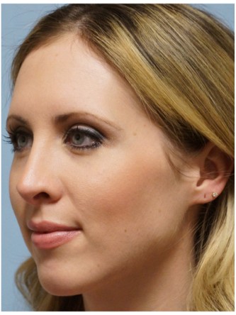 Crooked Nose & Cartilage Deformity1* — After