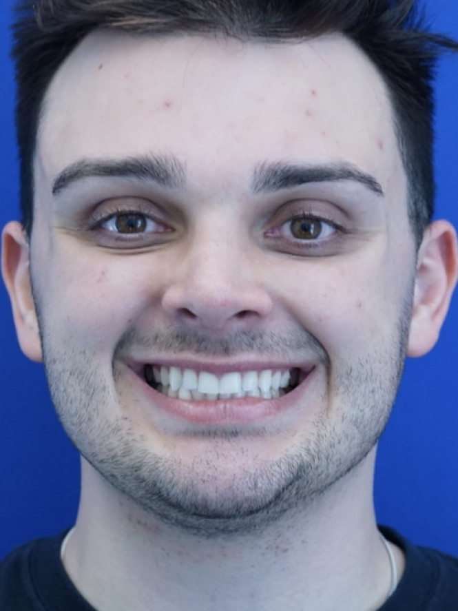 Profile Enhancement — After