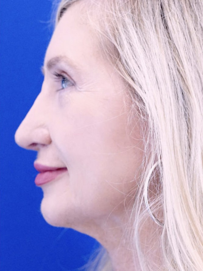 Thick Skin Droopy Nose — After