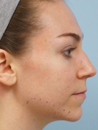 Fractional CO2 Laser Skin Resurfacing1* — Before