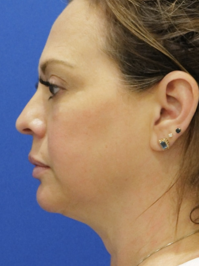 Deep Plane Rejuvenation — Before