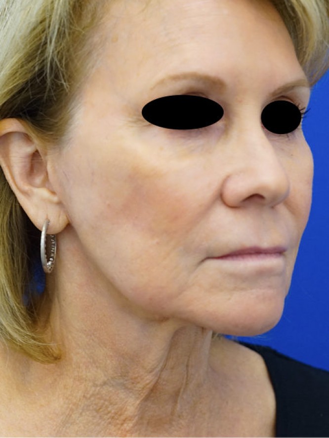 Secondary Deep Plane Facelift — Before