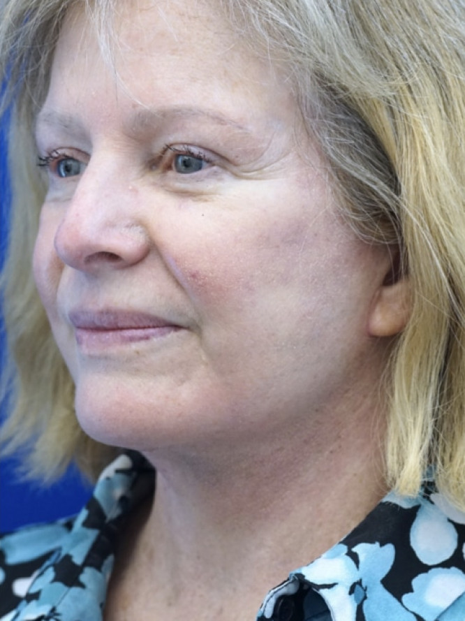 Deep Plane Jowl and Neck Lift — After