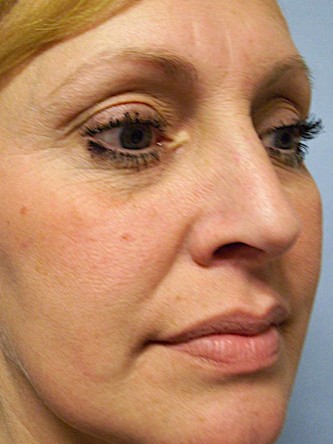 Mild Dorsal Hump & Droopy Tip2* — After