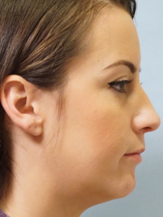 Repair of Nasal Septal Perforation* — After