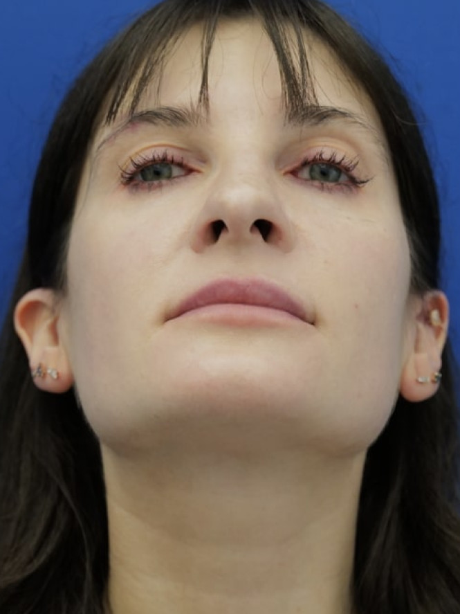Preserving Tip Surface Aesthetics — Before