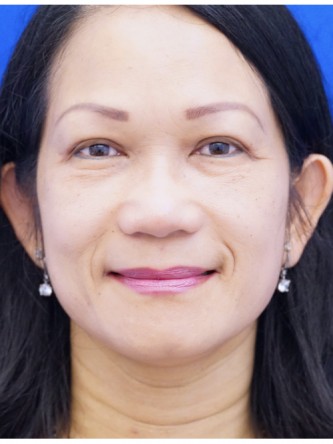 Asian Eyelid Crease Elevation — After