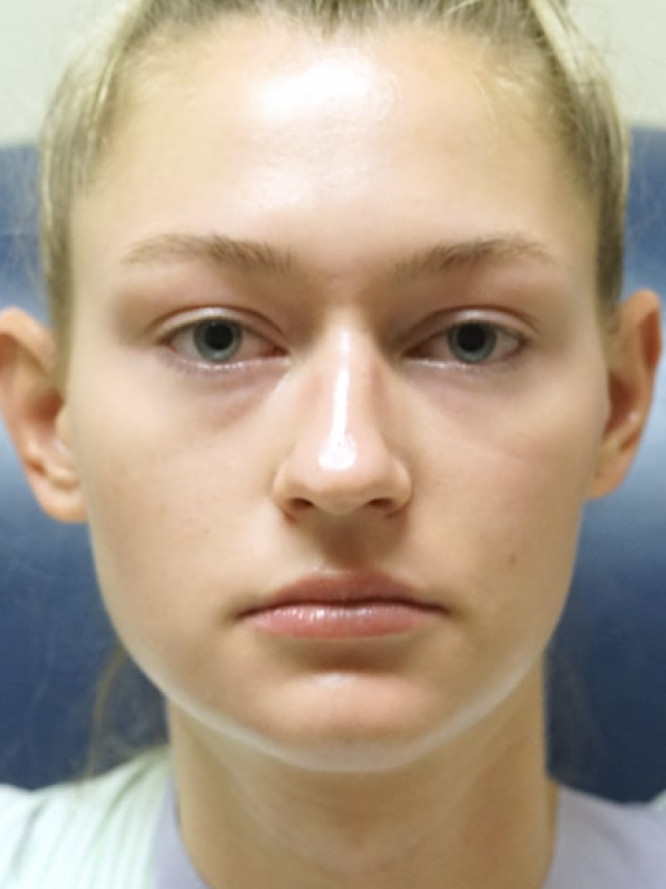 Nasal Profile Plasty — Before