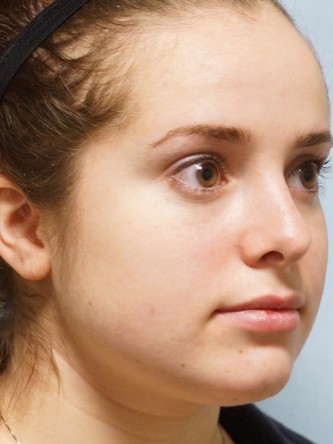 Crooked Nose Endonasal Technique1* — After