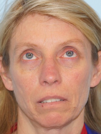 Upper Eyelid Droop1 (Ptosis)* — Before