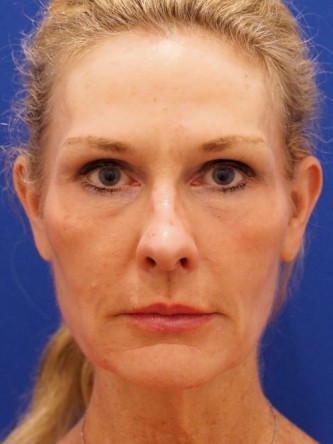 Mini Facelift* — Before