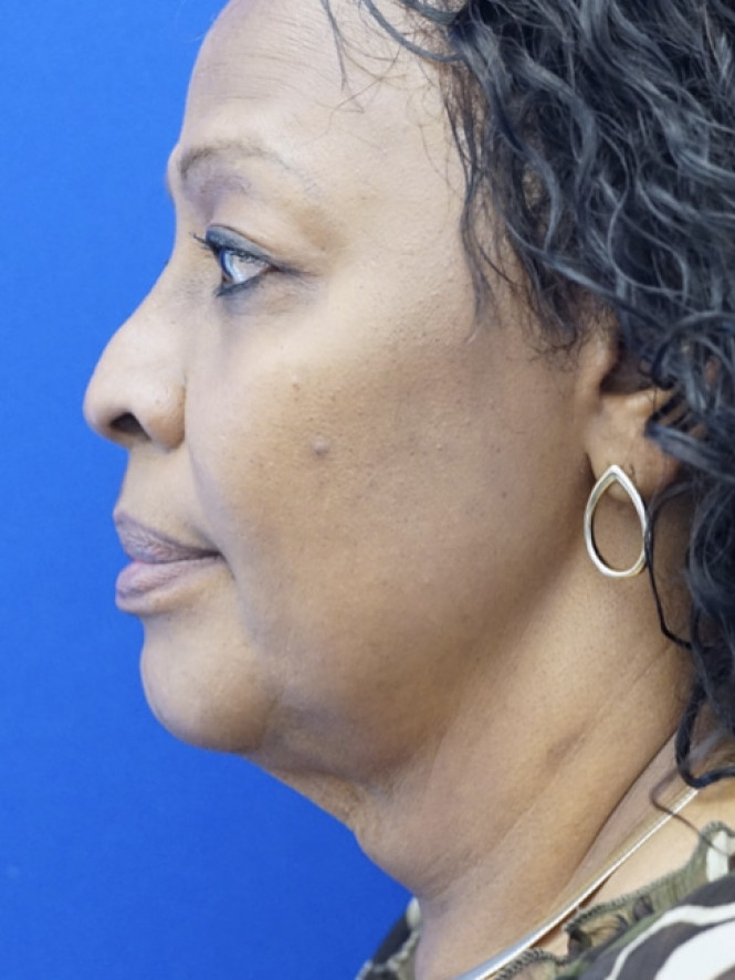 Necklift Platysma Suspension and Liposuction — Before