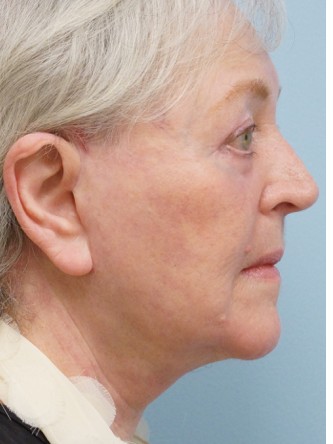Aging Eyelid, Facelift, Necklift, Fractional CO2 Laser Resurfacing* — After